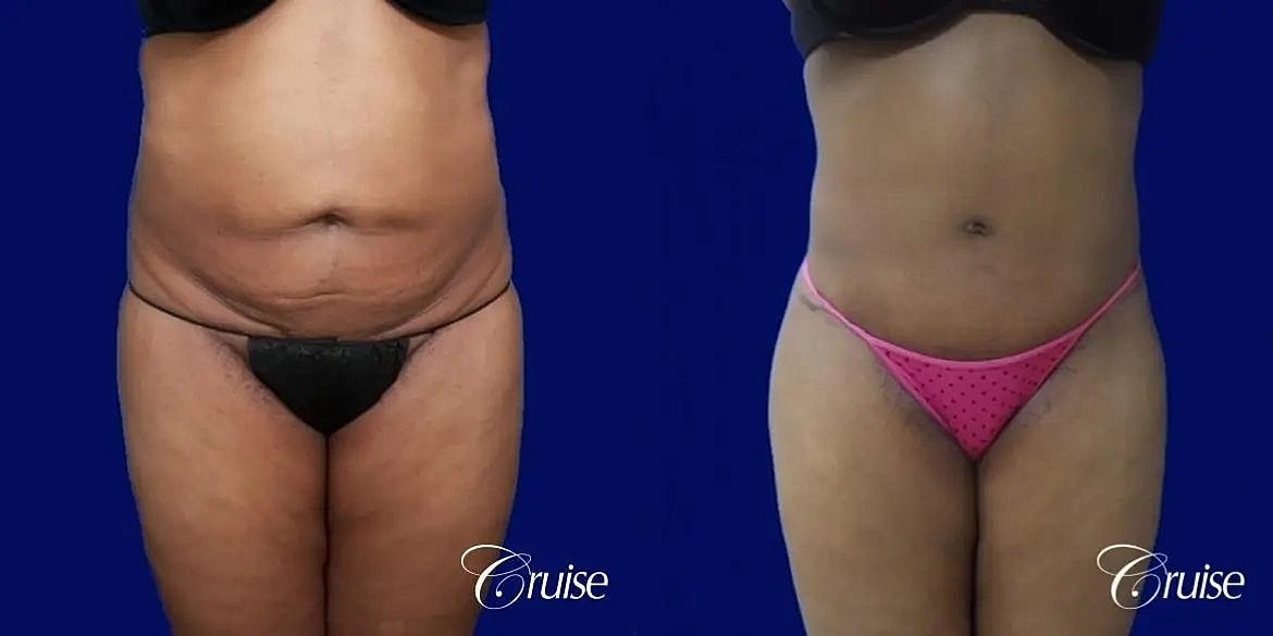 Liposuction Before & After