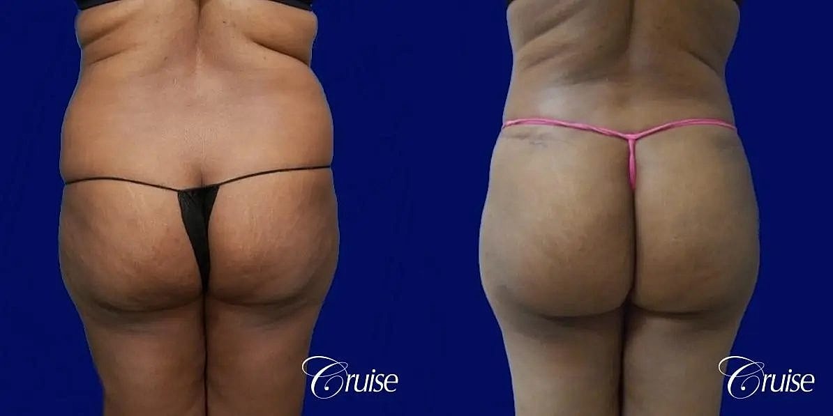 Liposuction Before & After