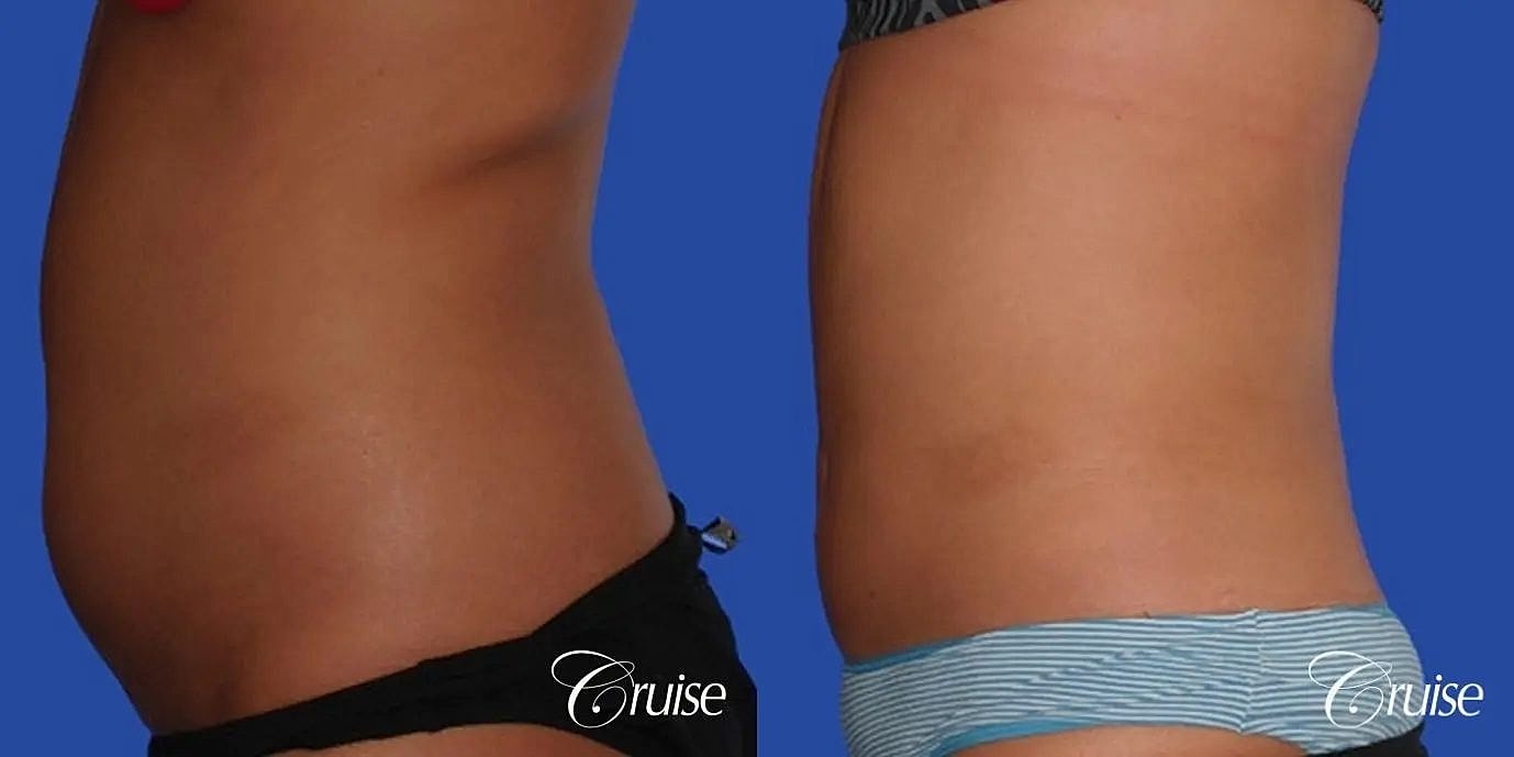 Liposuction Before & After