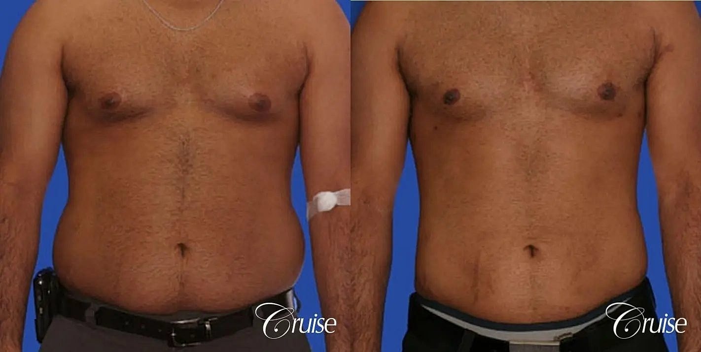 Liposuction Before & After