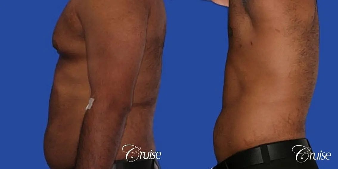 Liposuction Before & After