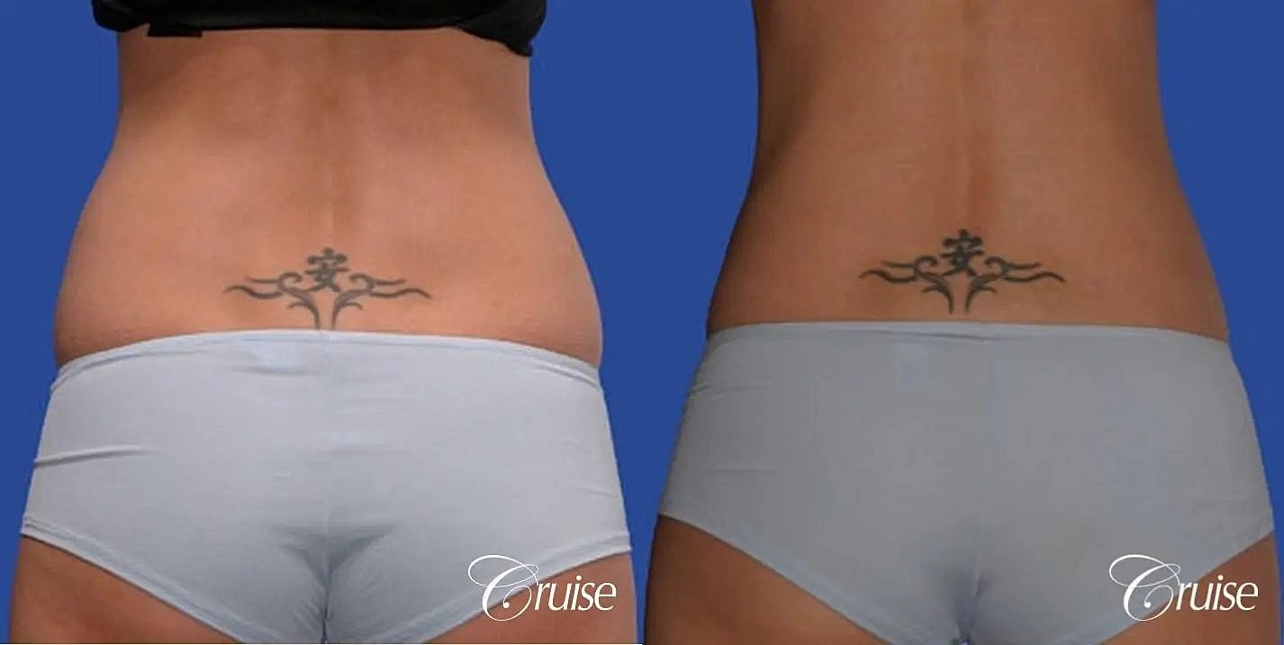 Liposuction Before & After