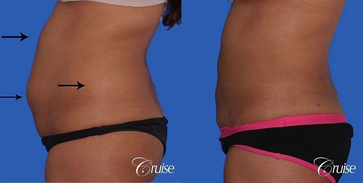 Liposuction Before & After
