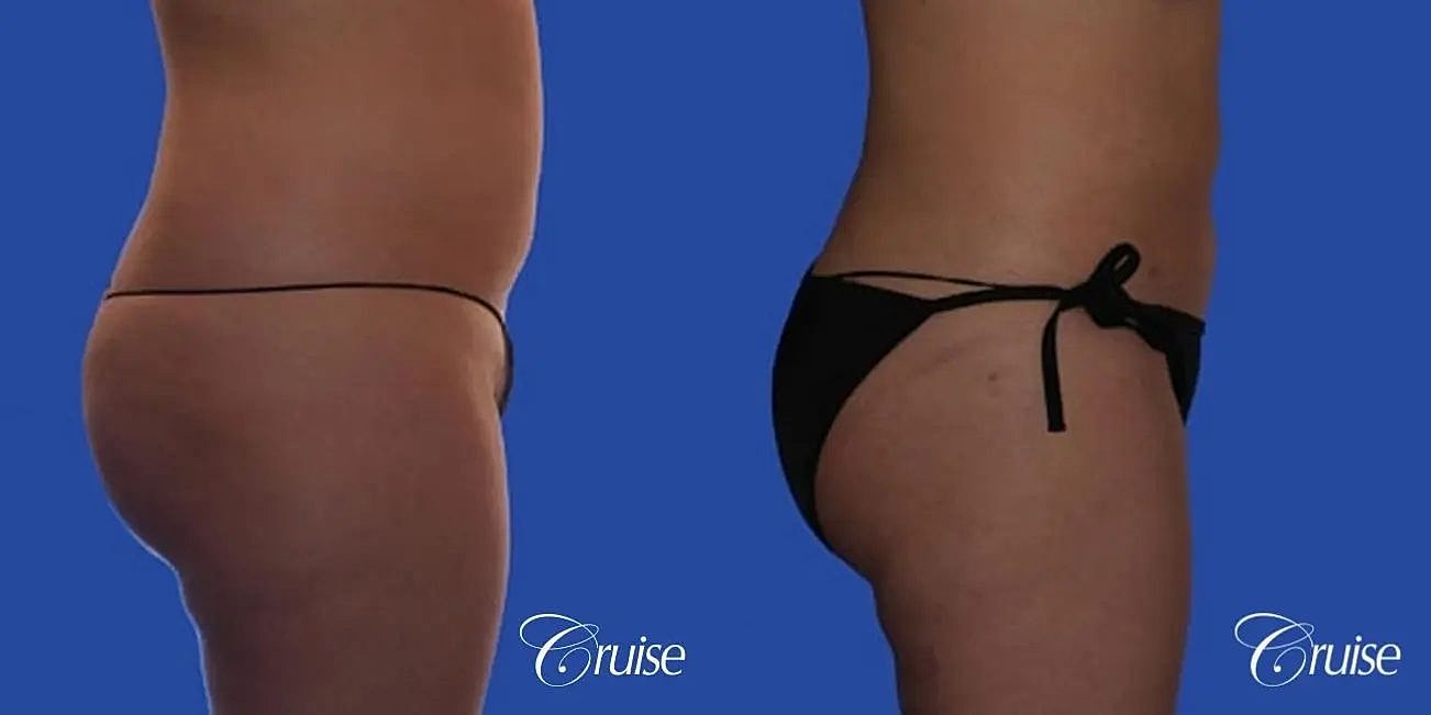 Liposuction Before & After