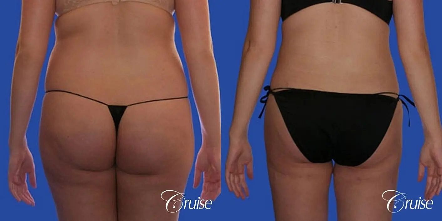 Liposuction Before & After