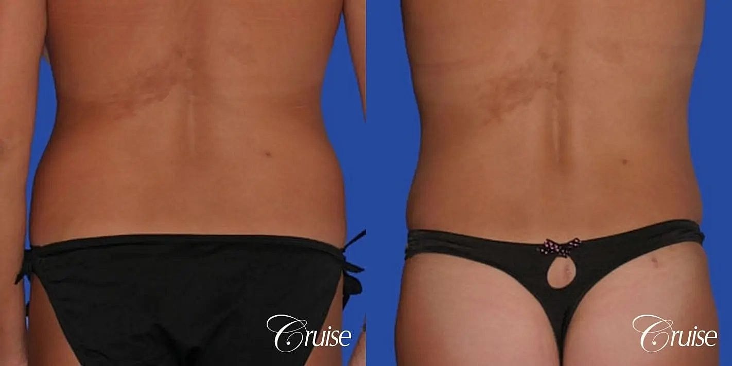 Liposuction Before & After