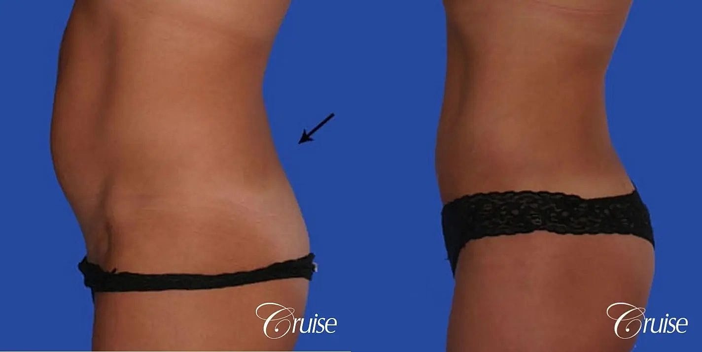 Liposuction Before & After