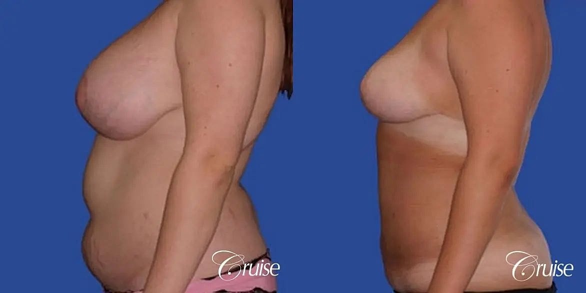 Liposuction Before & After