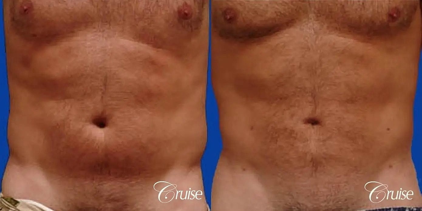 Liposuction Before & After
