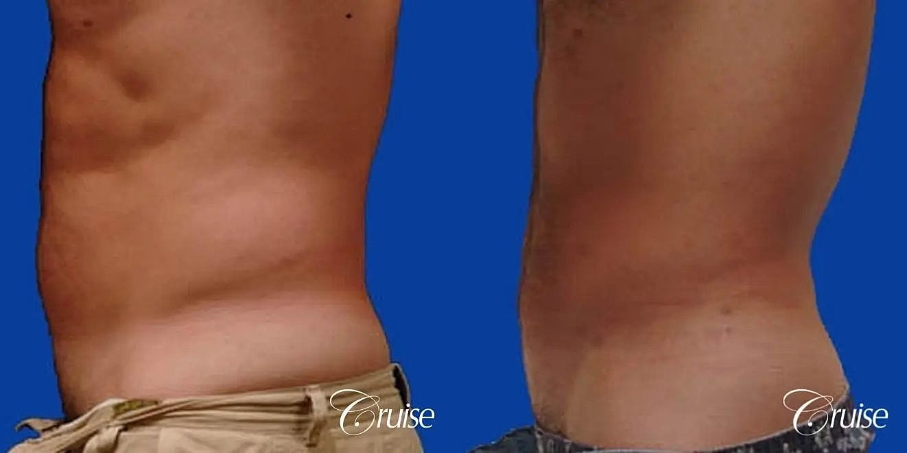 Liposuction Before & After