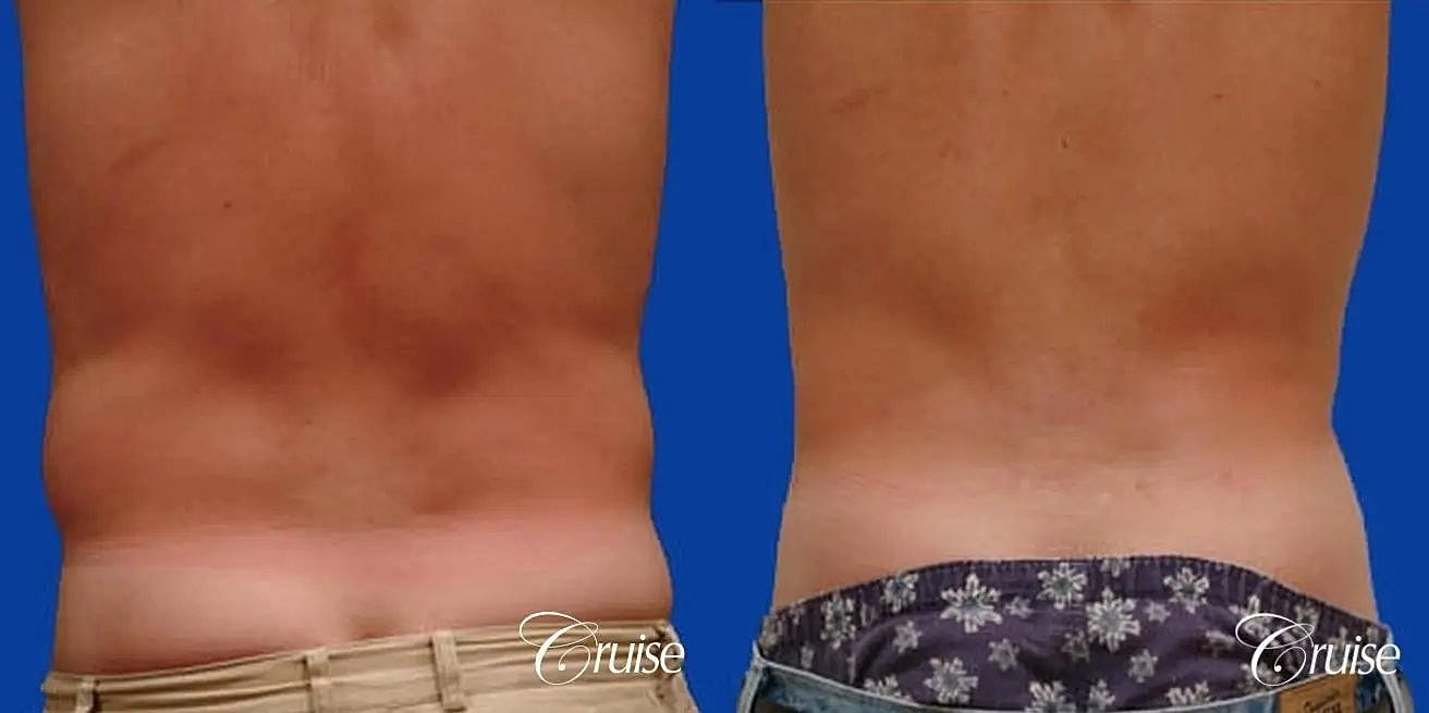 Liposuction Before & After