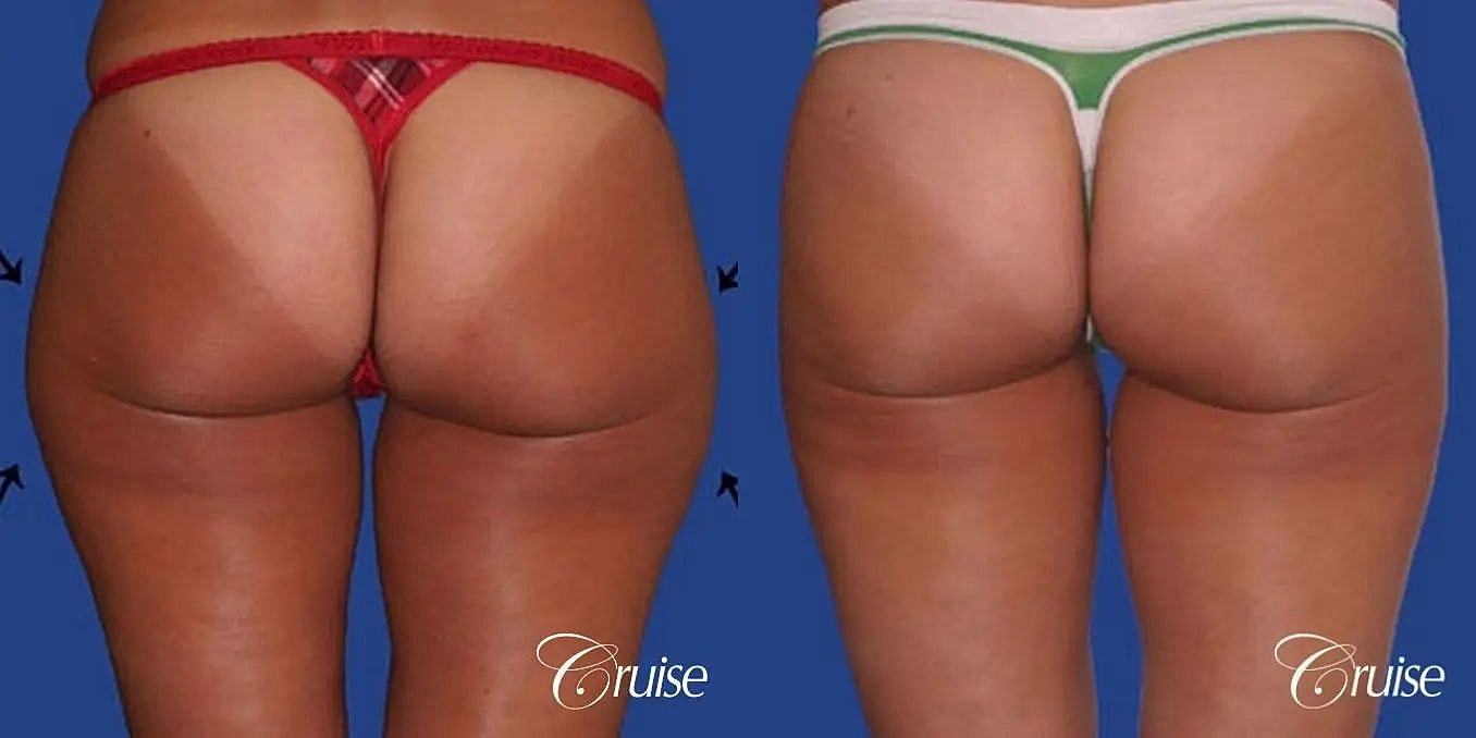 Liposuction Before & After