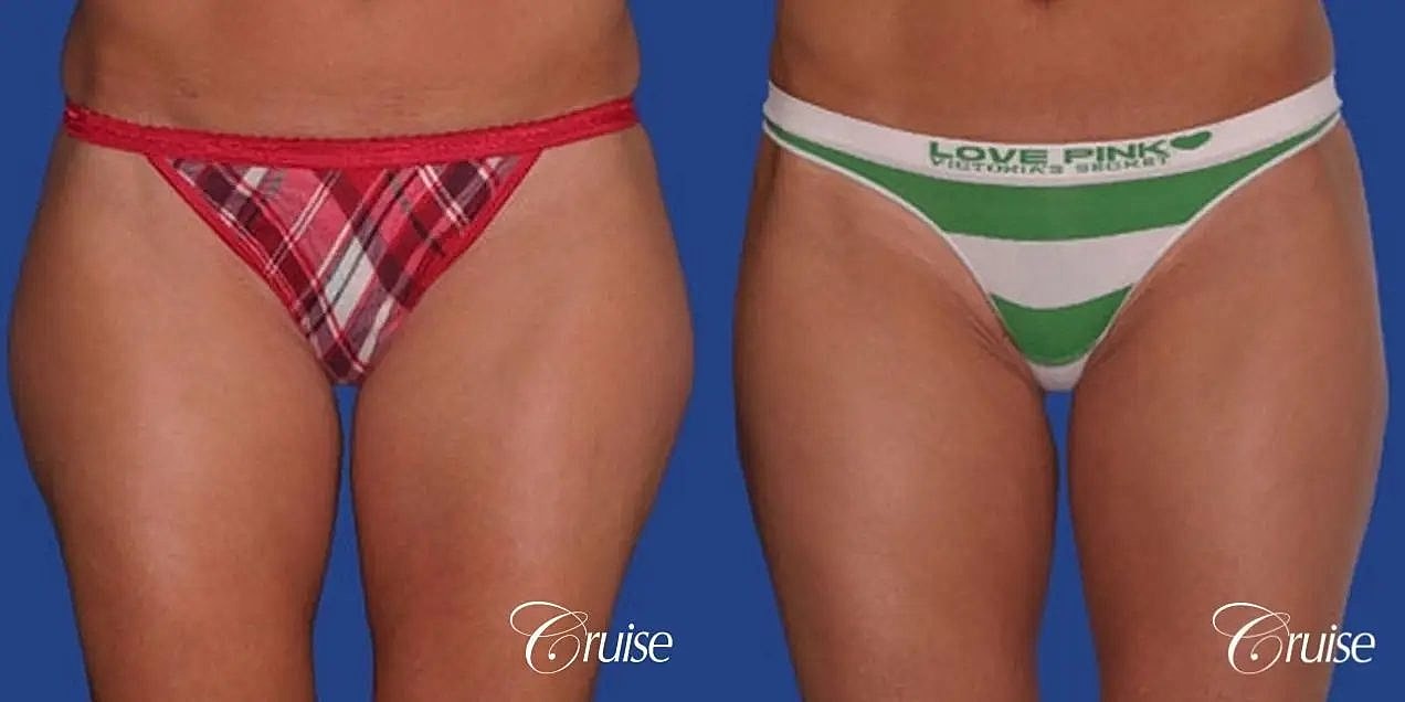 Liposuction Before & After