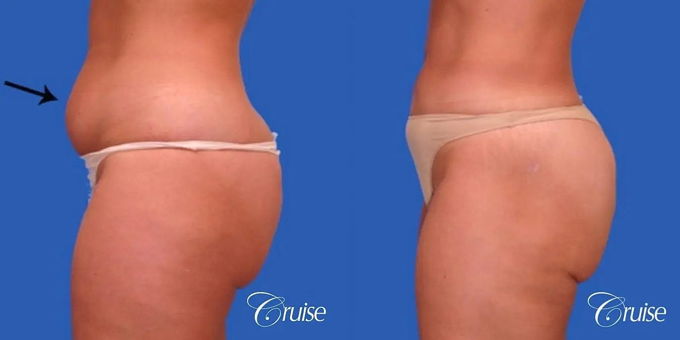 Liposuction Before & After