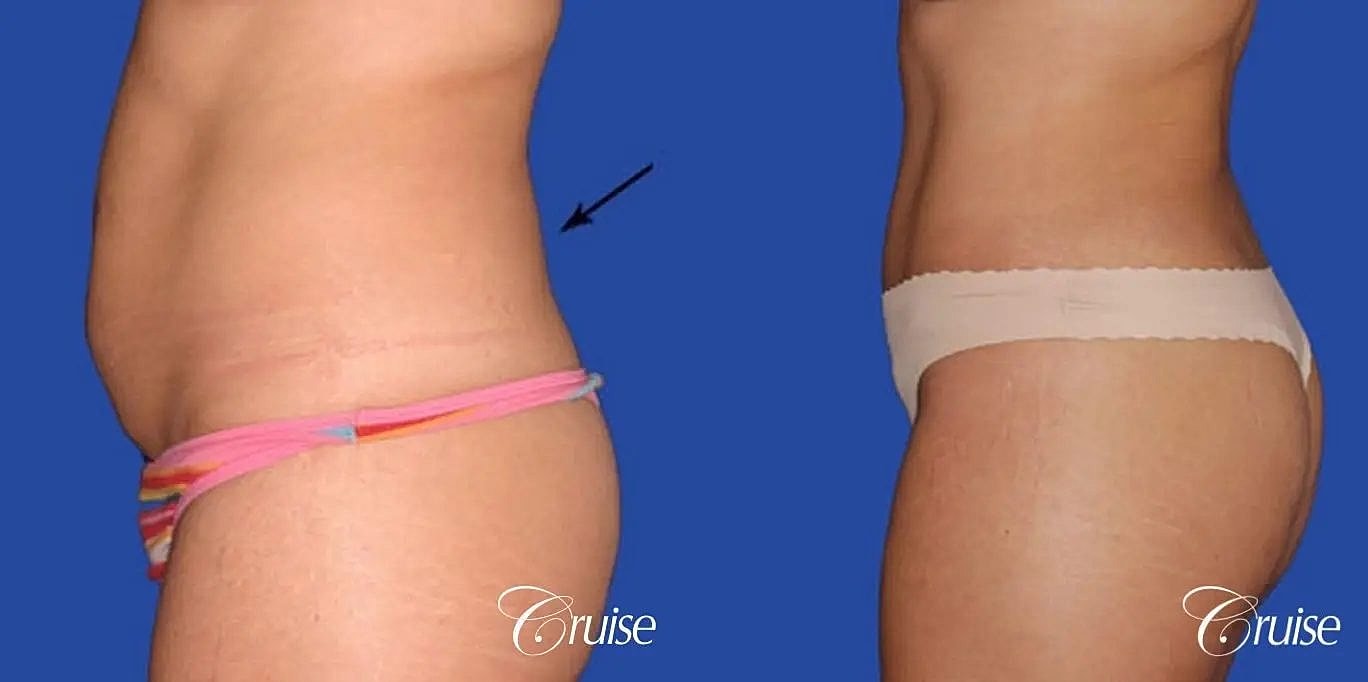 Liposuction Before & After