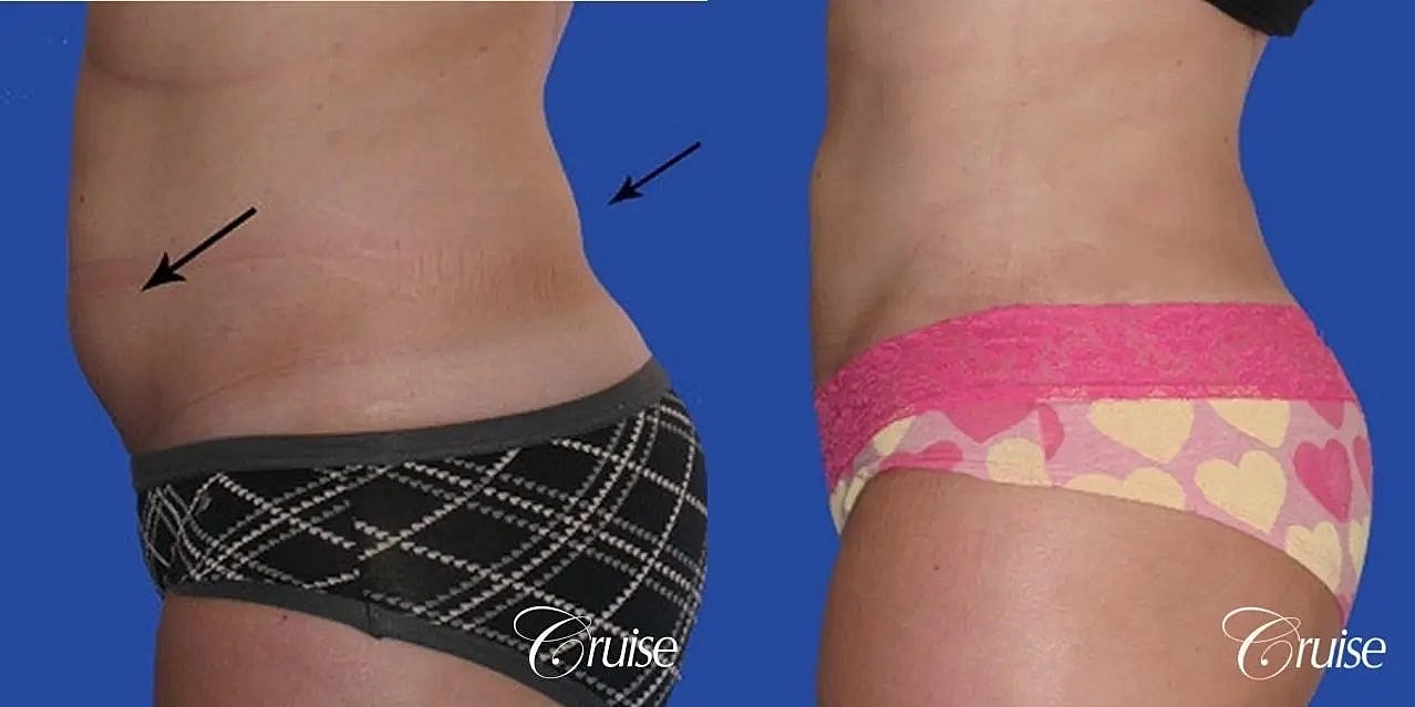 Liposuction Before & After