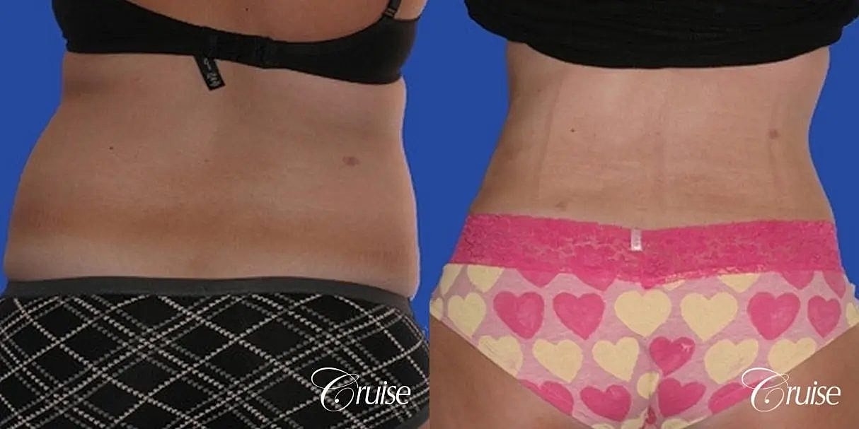 Liposuction Before & After