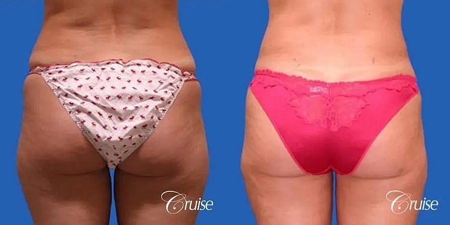 Liposuction Before & After