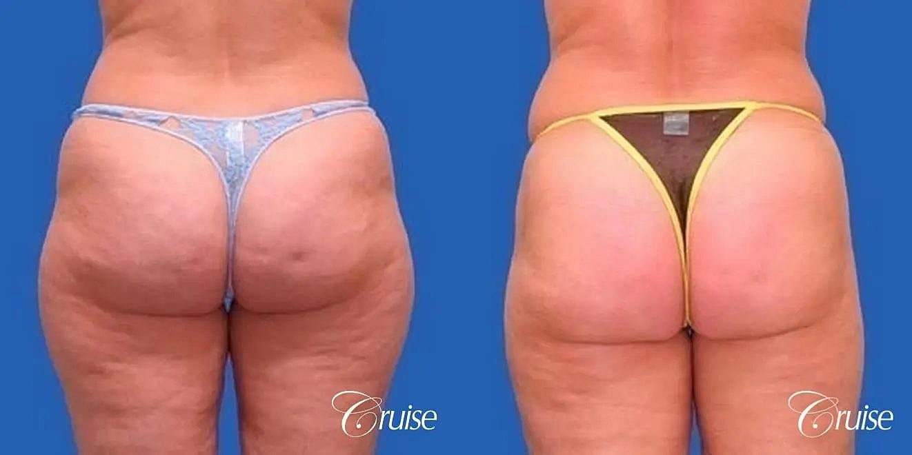 Liposuction Before & After