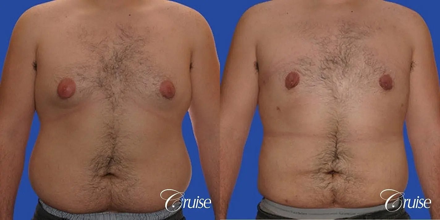 Liposuction Before & After