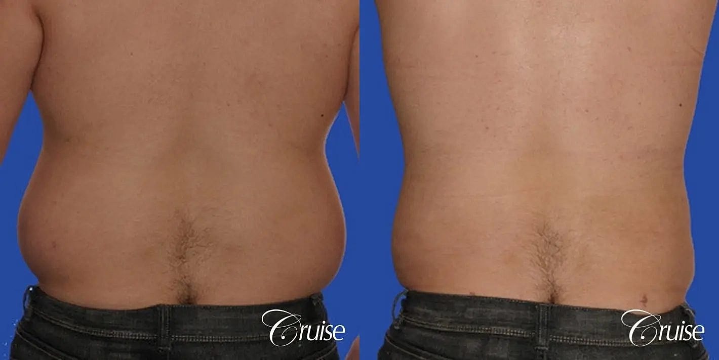 Liposuction Before & After
