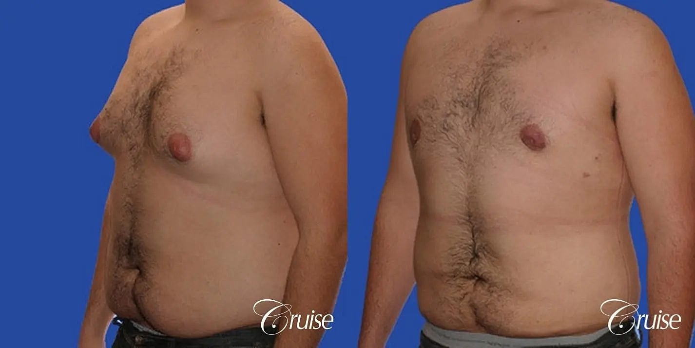 Liposuction Before & After
