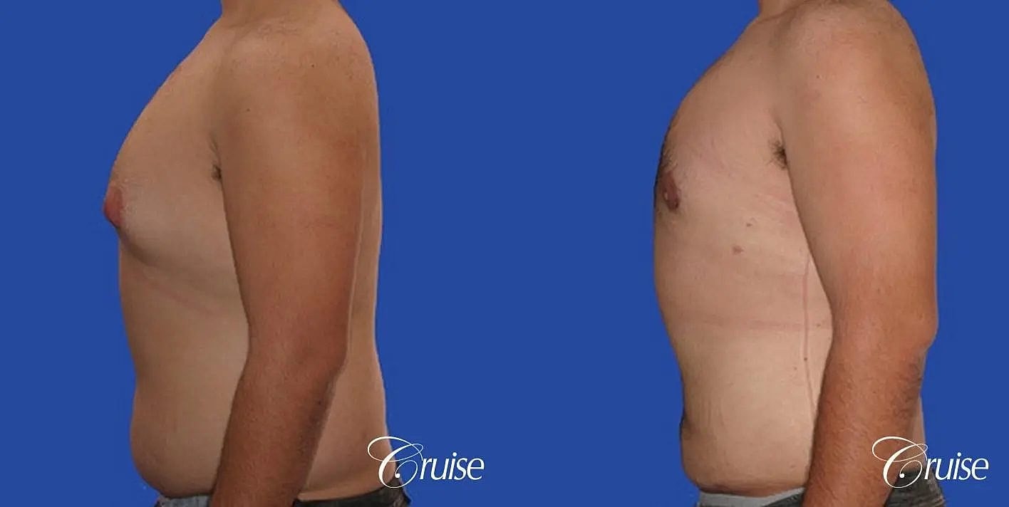 Liposuction Before & After