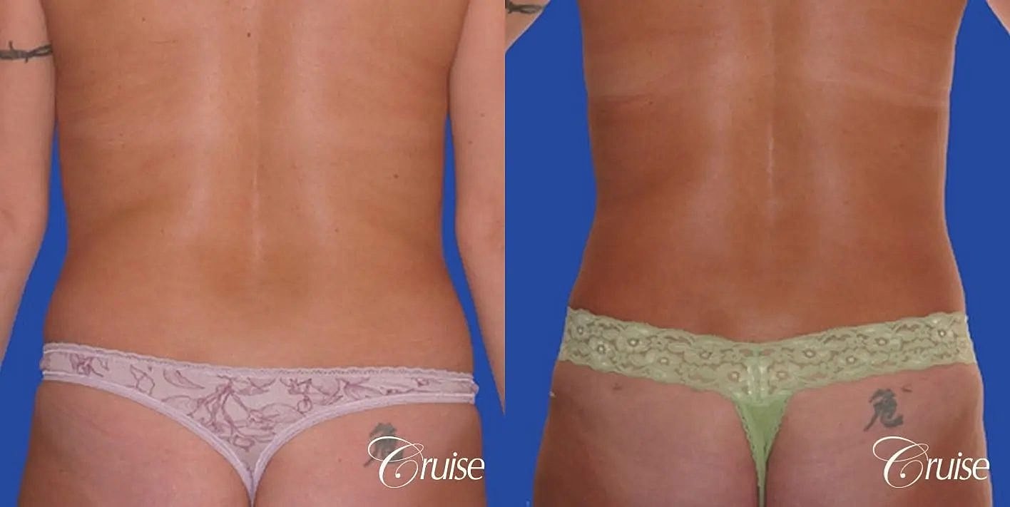 Liposuction Before & After