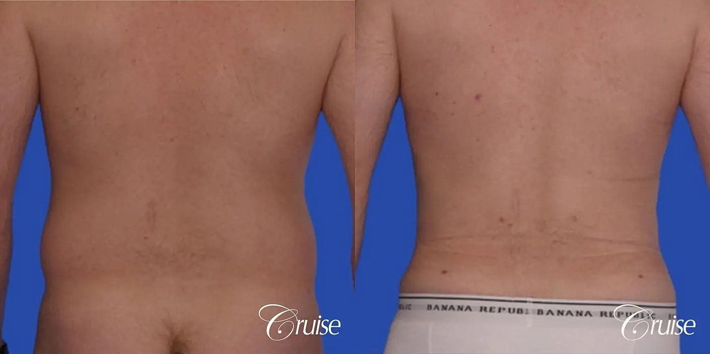 Liposuction Before & After