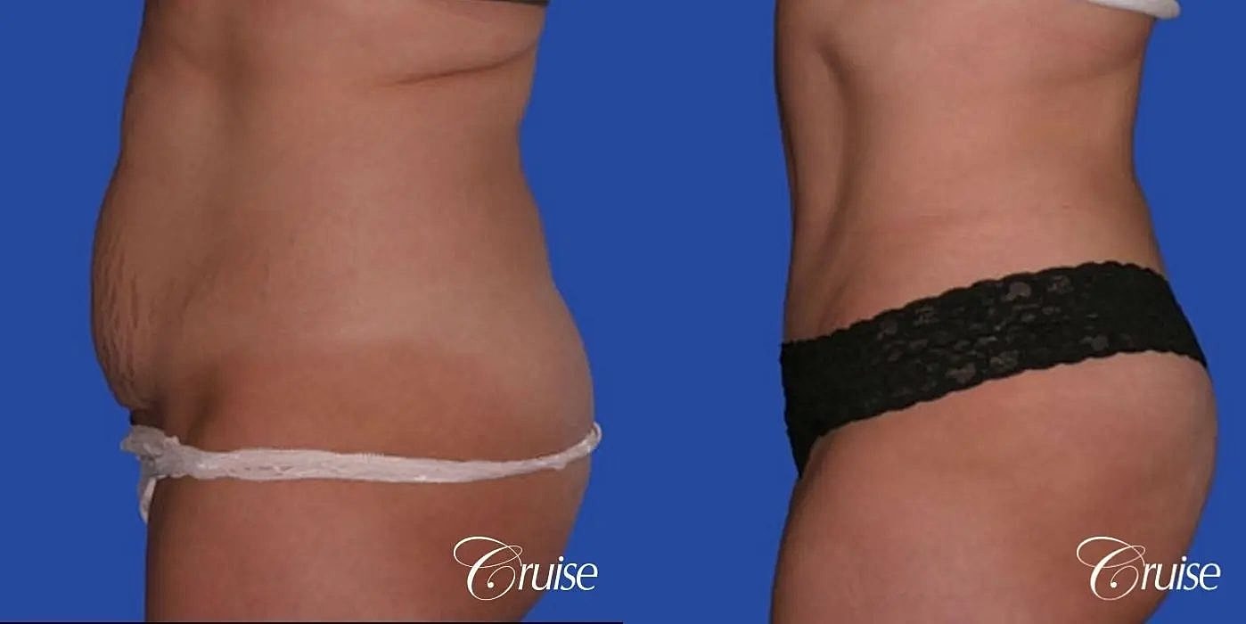 Liposuction Before & After
