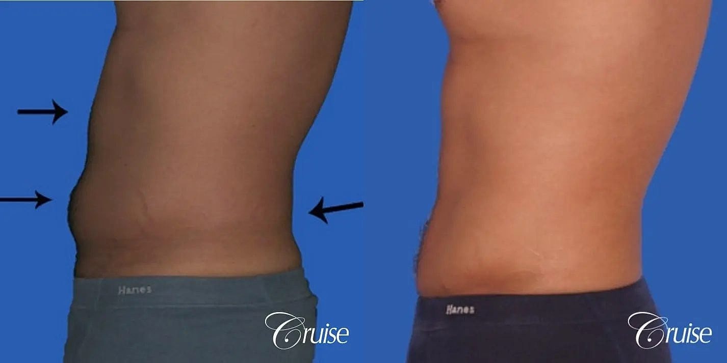 Liposuction Before & After