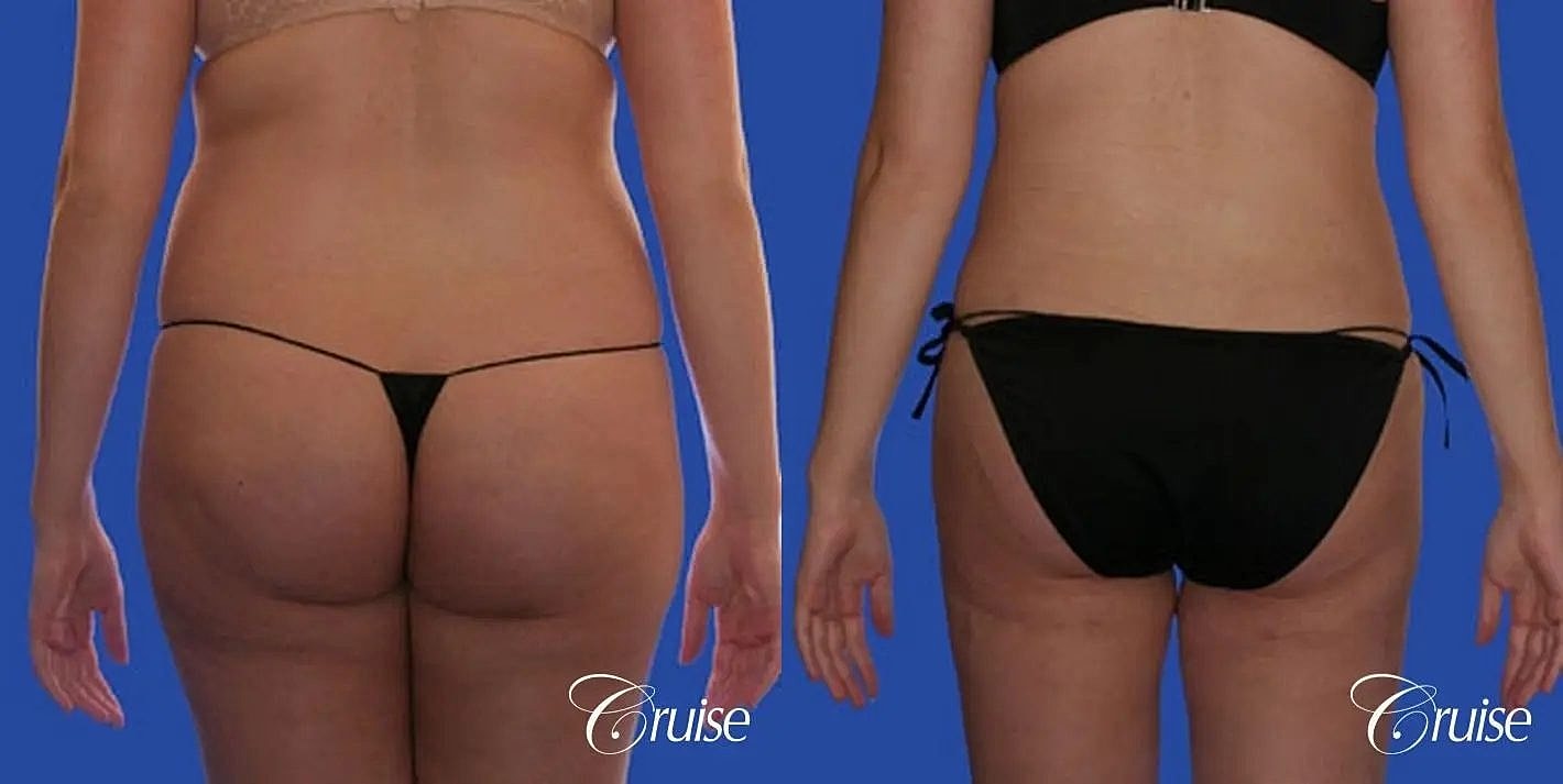 Liposuction Before & After