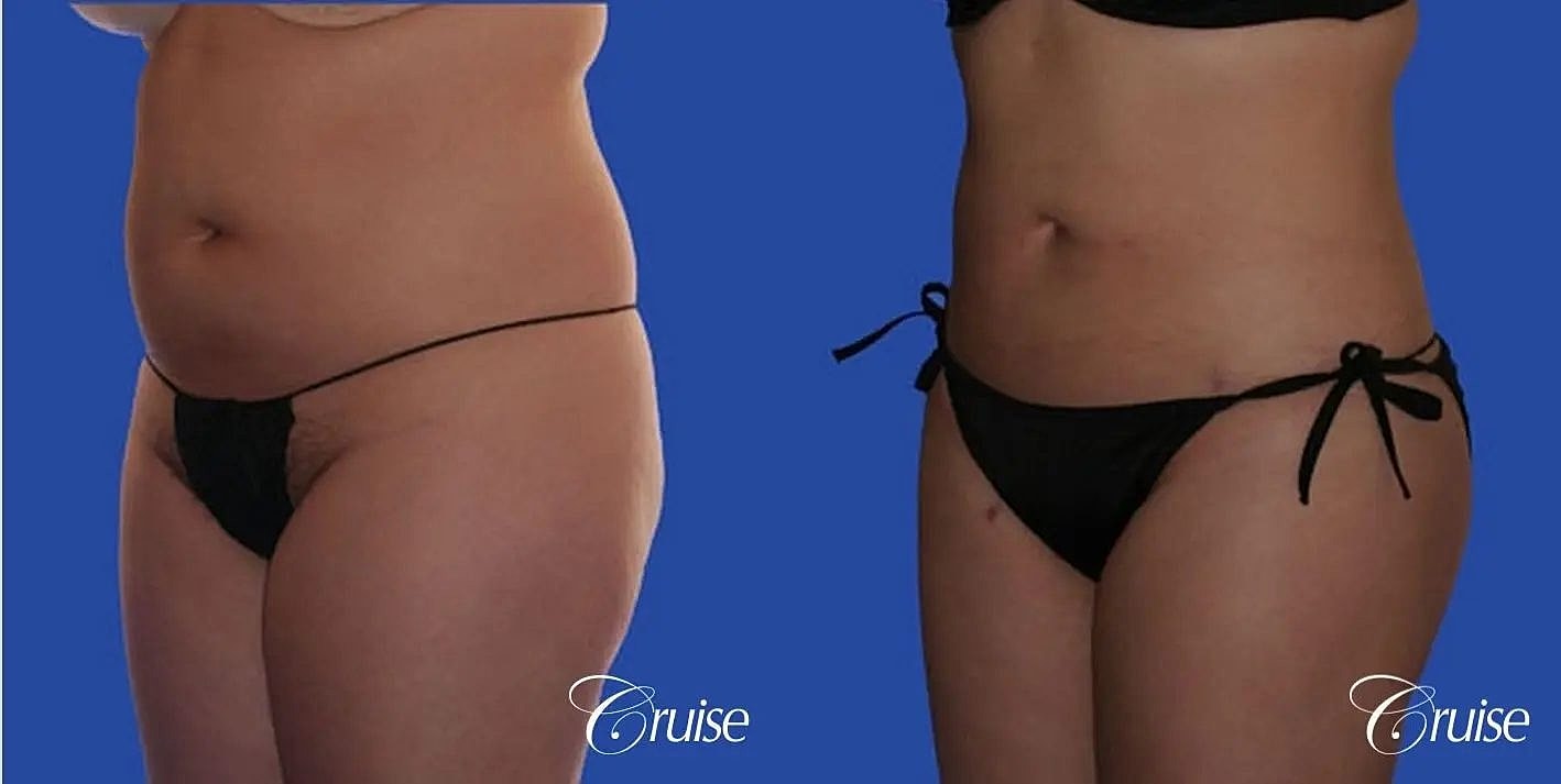 Liposuction Before & After