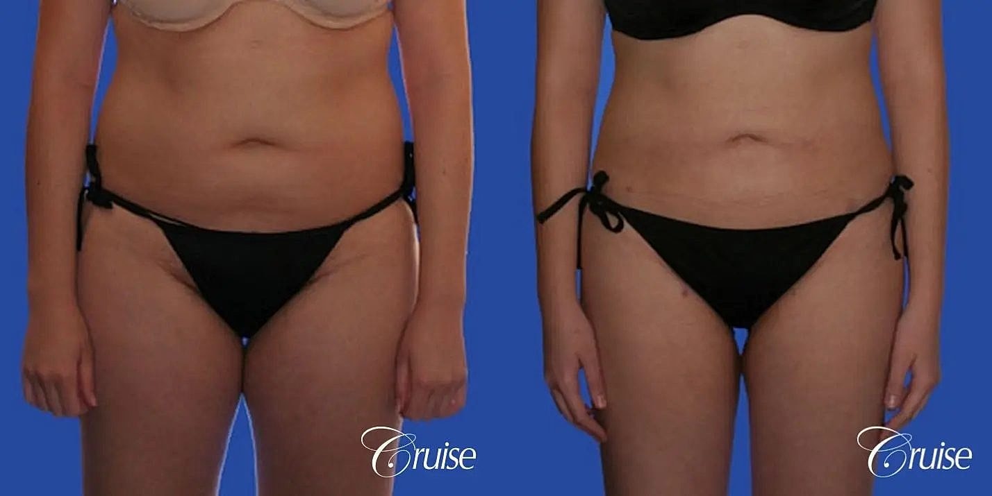 Liposuction Before & After