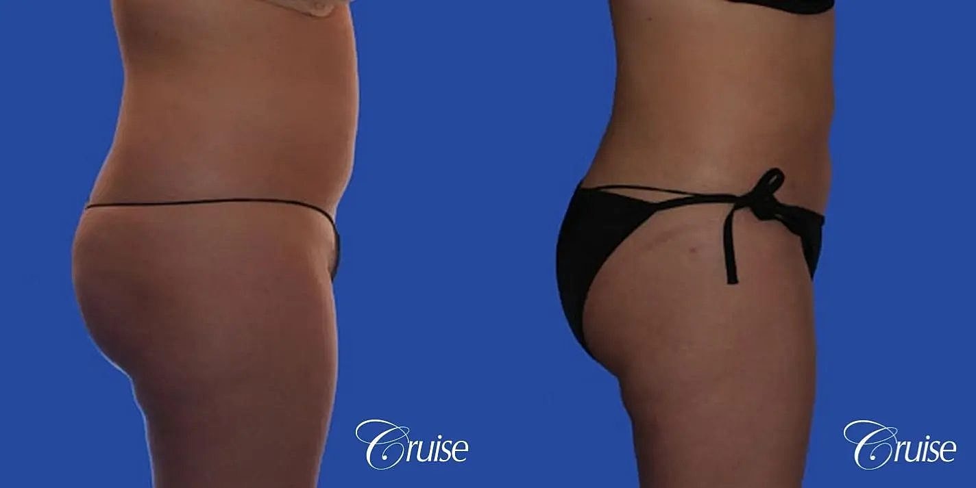 Liposuction Before & After