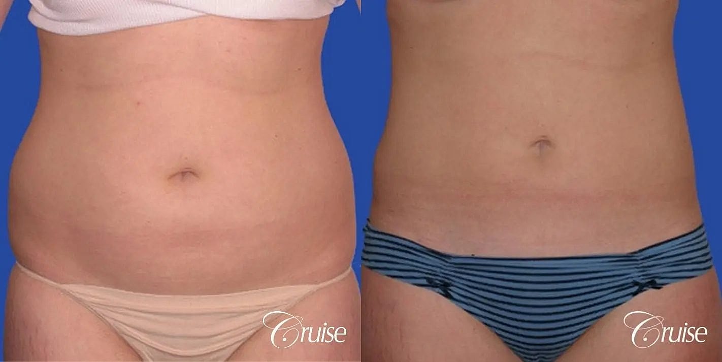 Liposuction Before & After