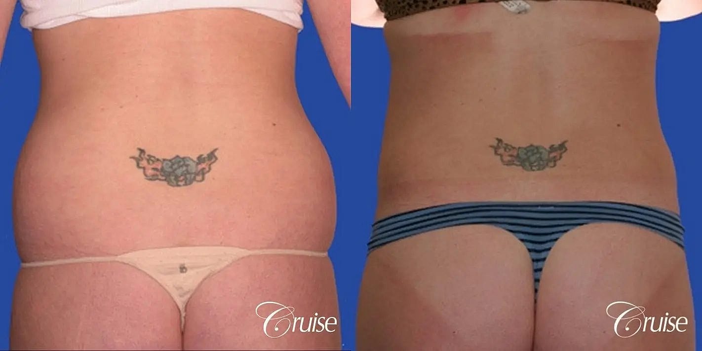 Liposuction Before & After