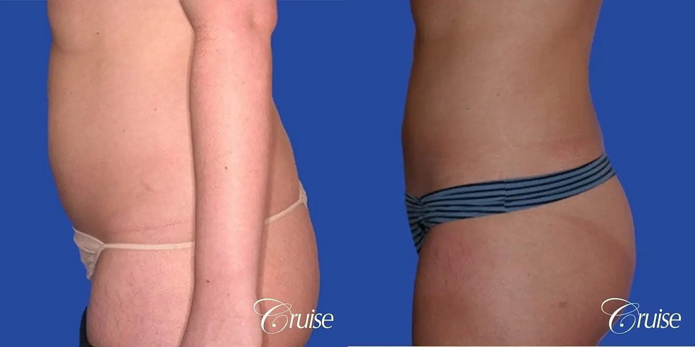 Liposuction Before & After