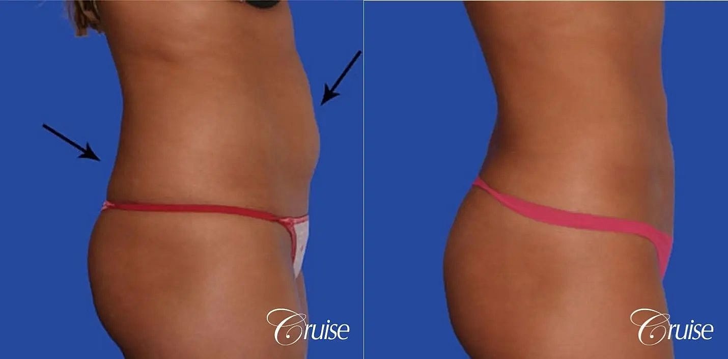 Liposuction Before & After