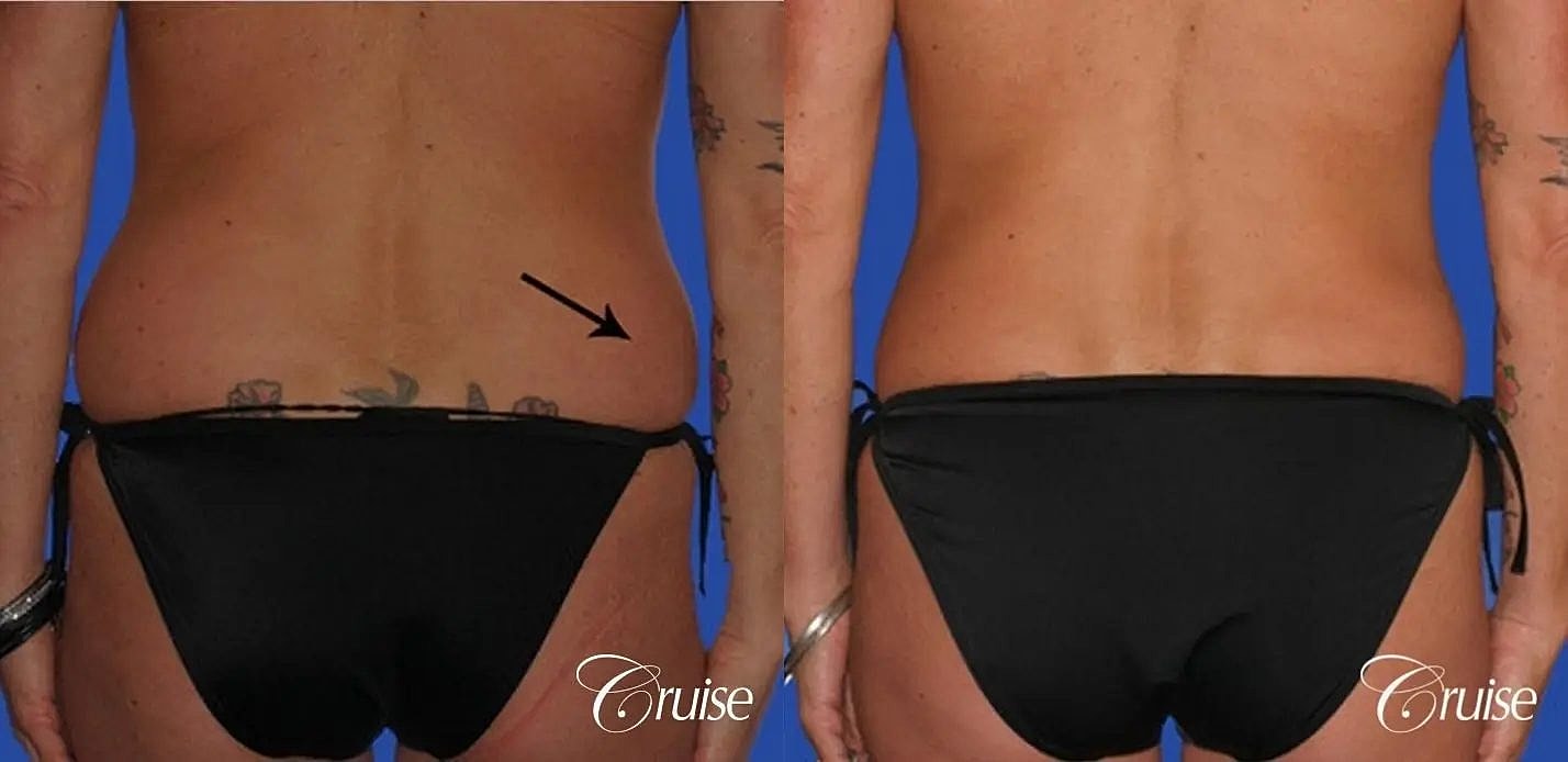 Liposuction Before & After