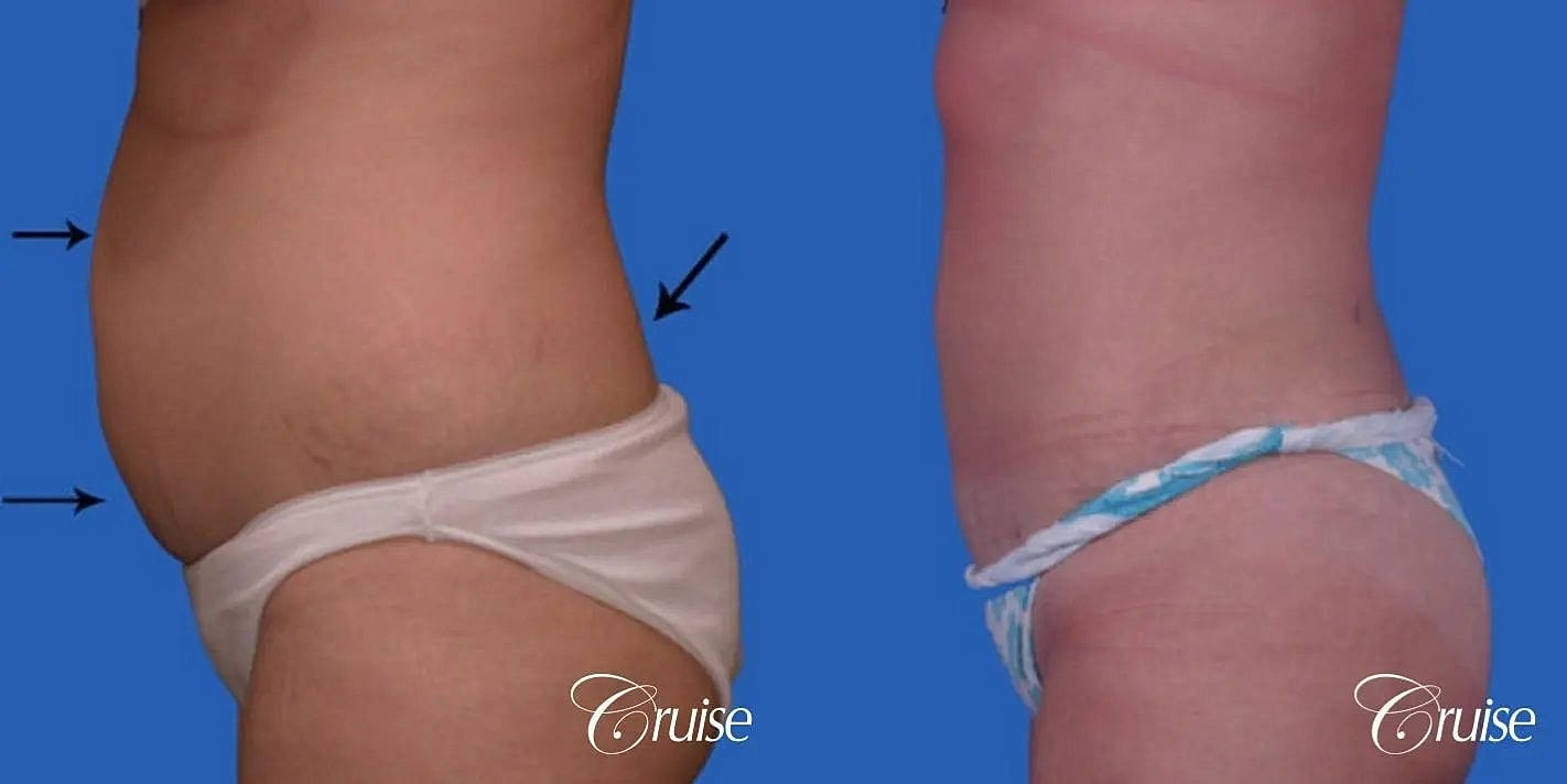 Liposuction Before & After