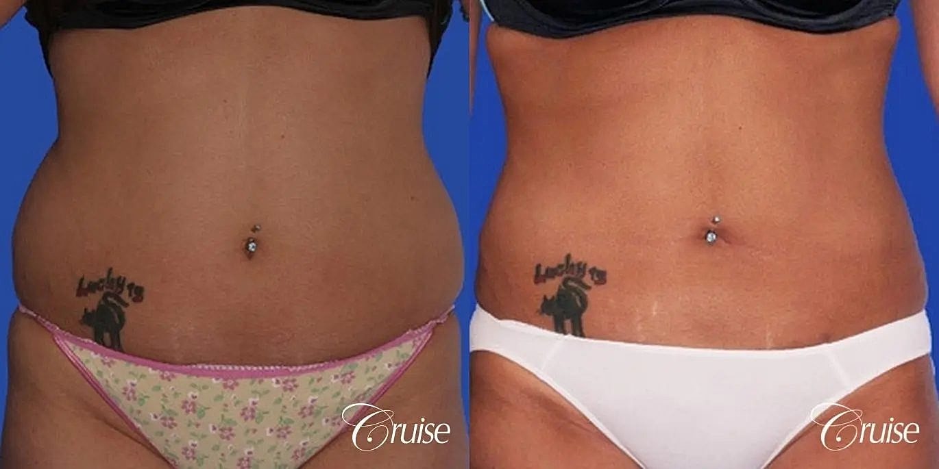 Liposuction Before & After