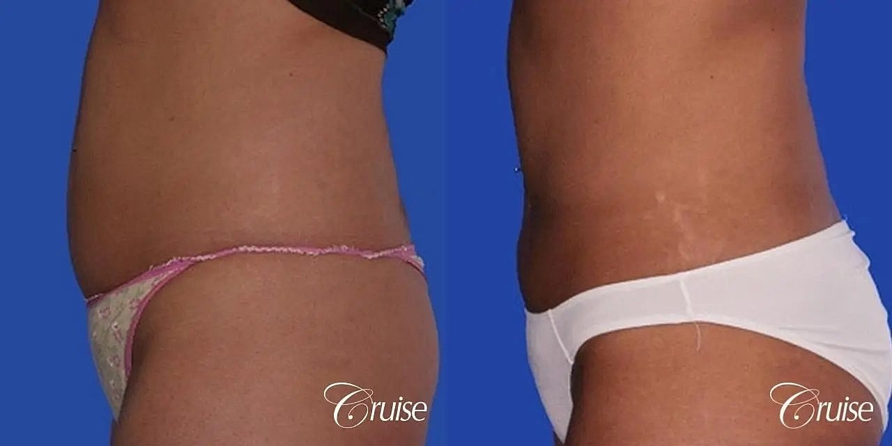Liposuction Before & After