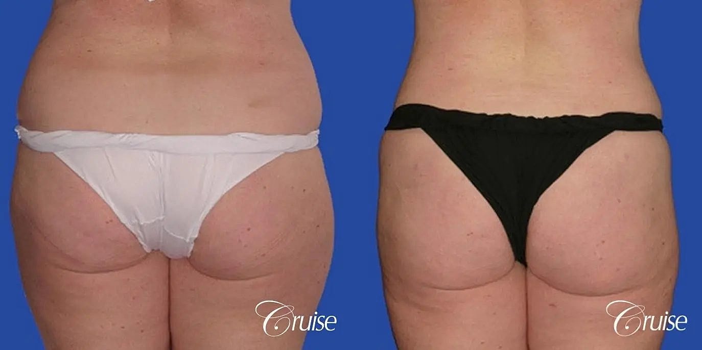Liposuction Before & After