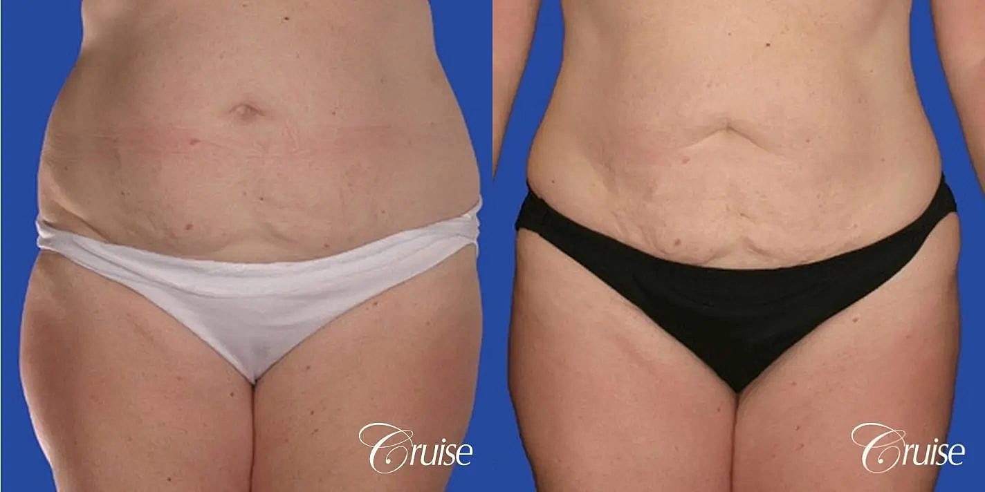 Liposuction Before & After