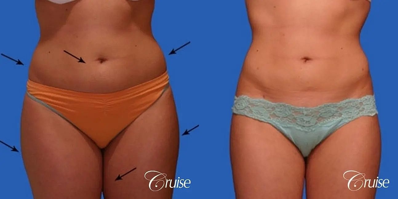 Liposuction Before & After