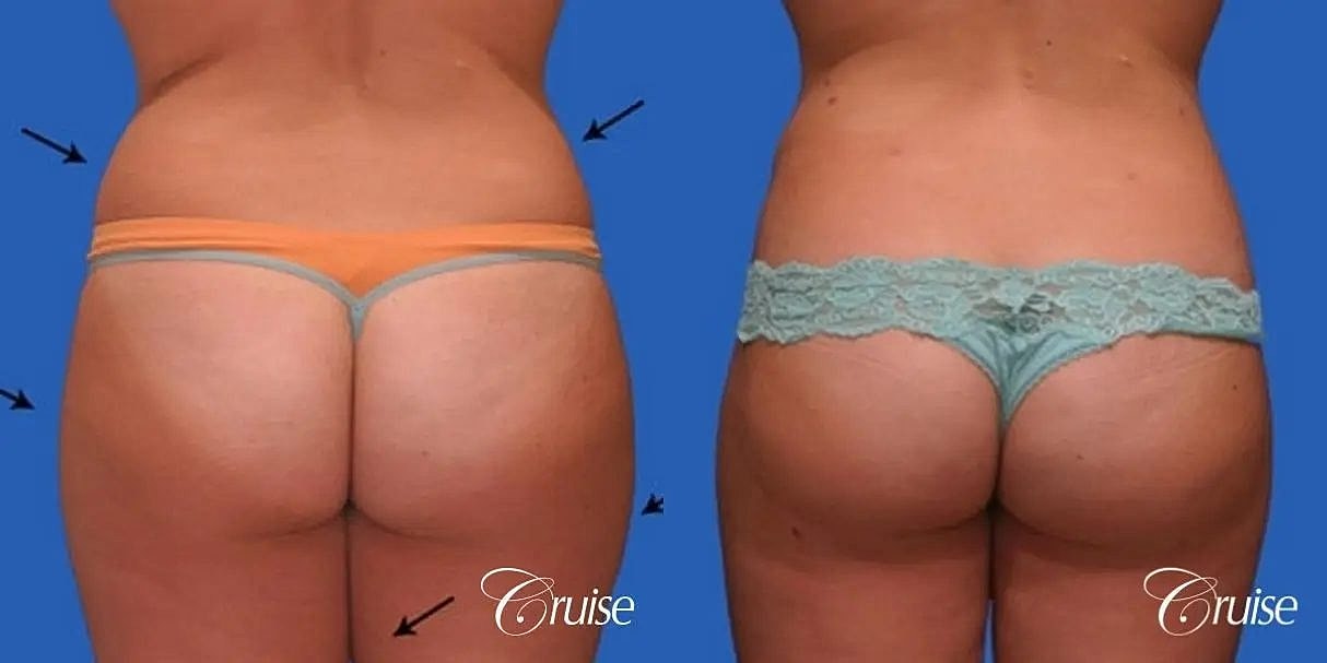 Liposuction Before & After