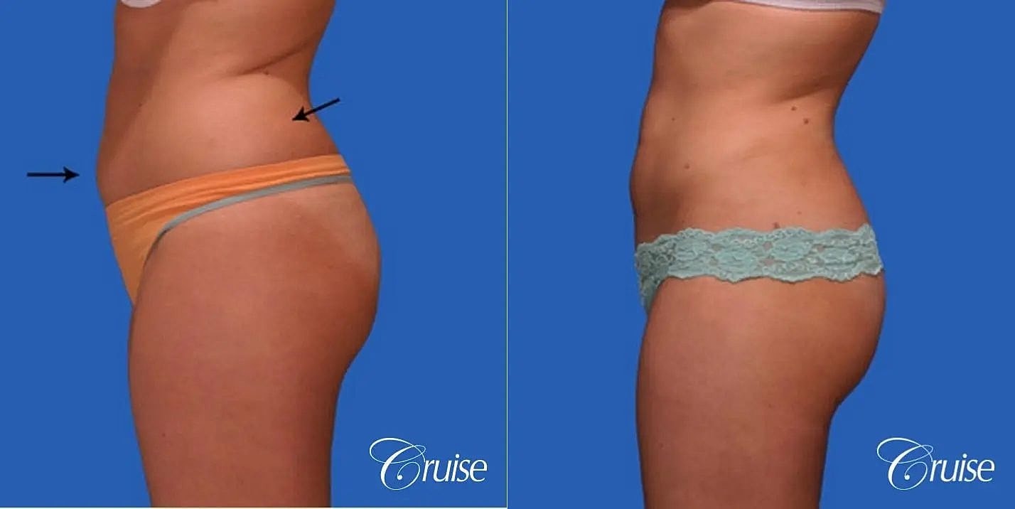 Liposuction Before & After