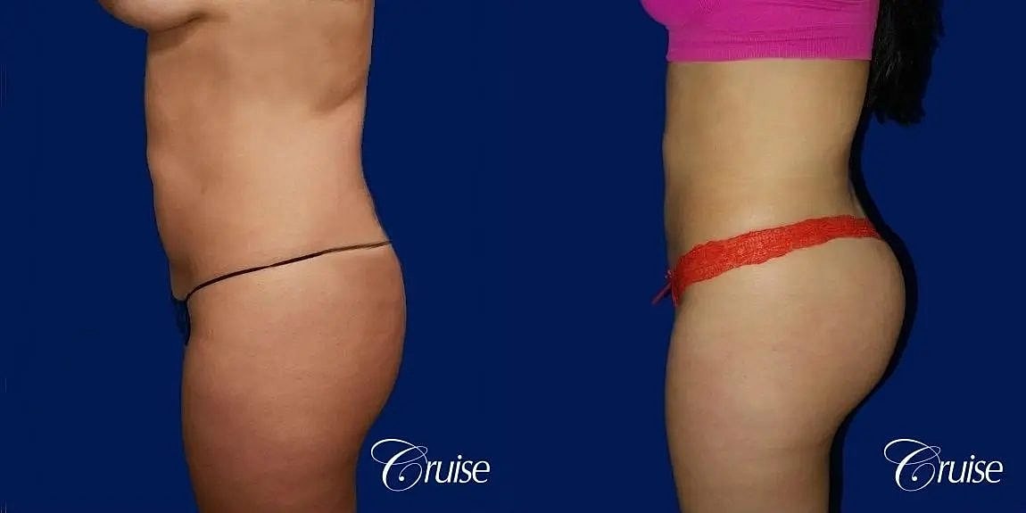 Liposuction Before & After