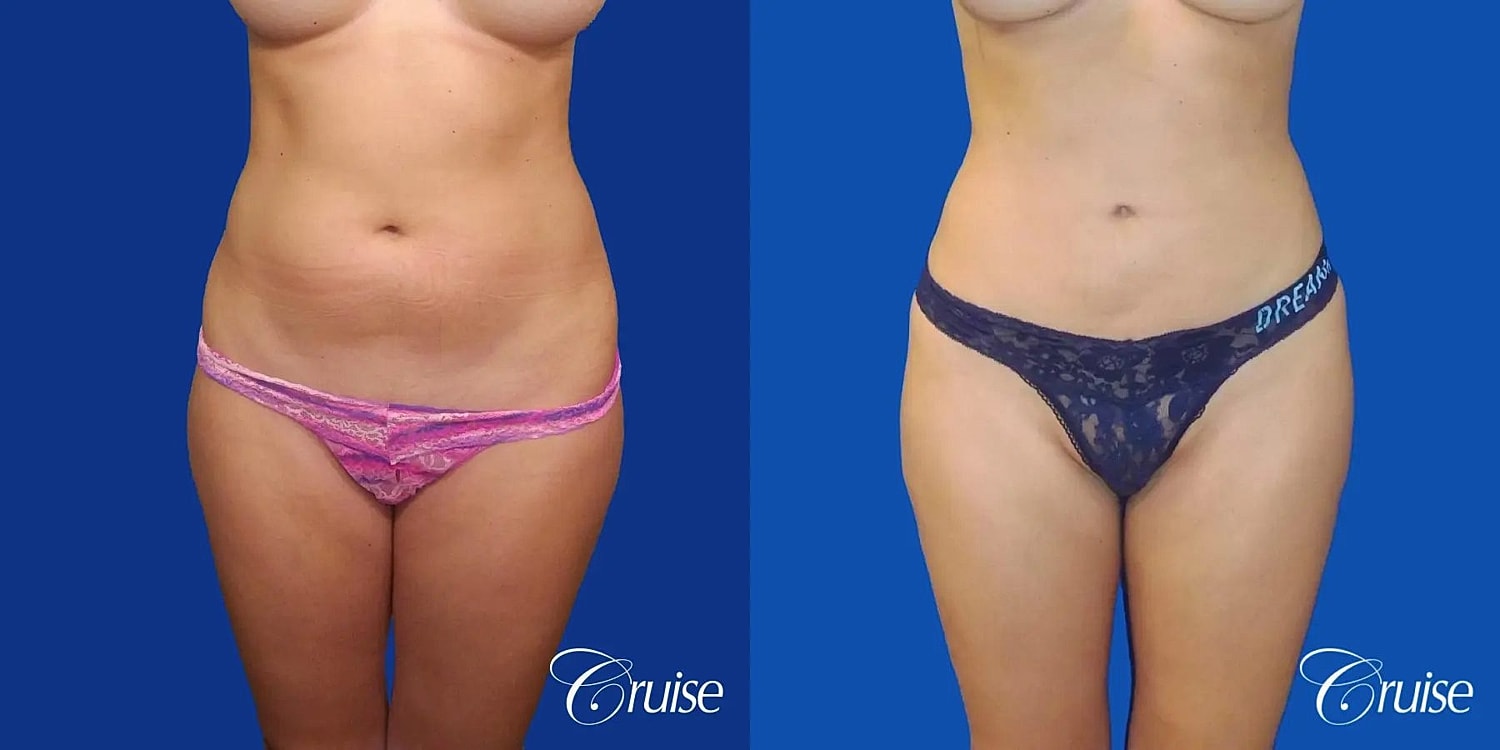 Liposuction Before & After